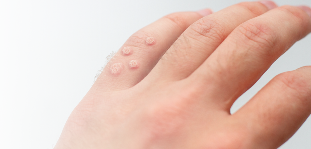 Darf Man Mit Pflaster Ins Schwimmbad Achtung zahlreiche Krankheiten im Schwimmbad