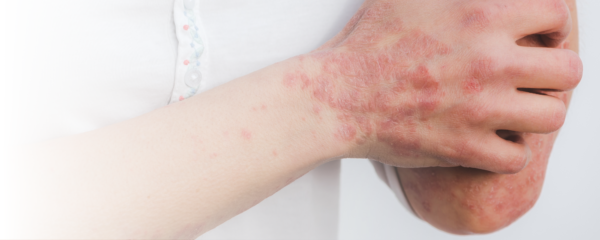 Ekzeme - Alles über Symptome, Auslöser und Behandlung