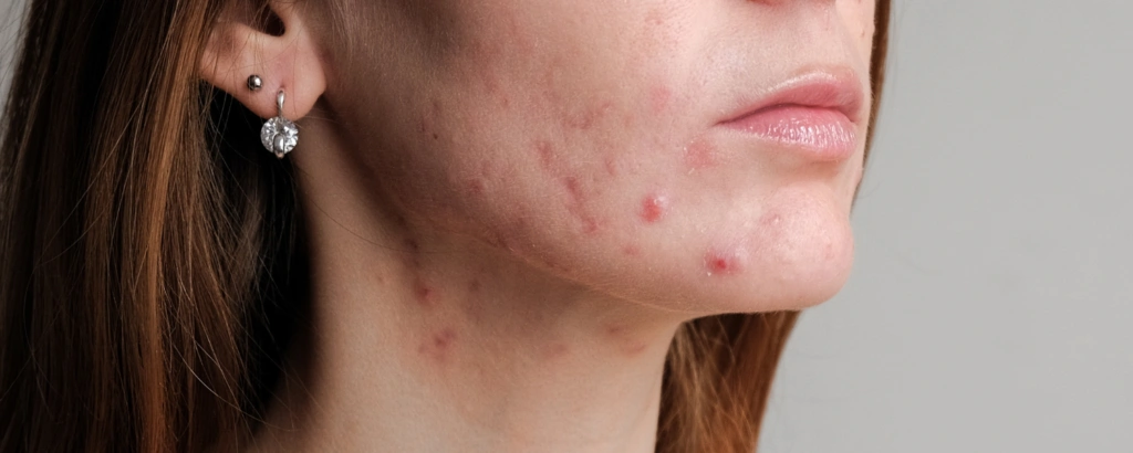 Papeln im Gesicht einer Frau