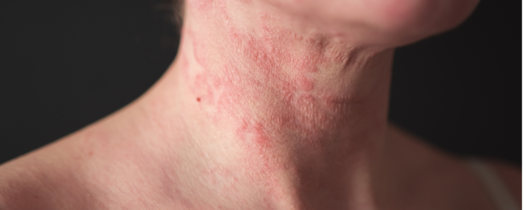 Hautausschlag / Dermatitis am Hals