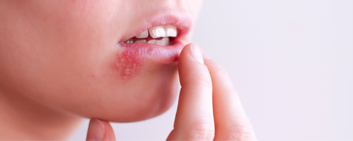Lippenherpes In Der Frühen Schwangerschaft