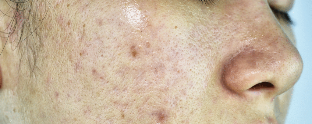 Postinflammatorische Hyperpigmentierung (Pickelmale) Akne im Gesicht