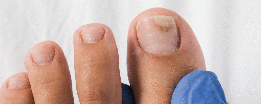 Onycholyse, Ablösung des Nagels am großen Zeh, Nageldystrophie