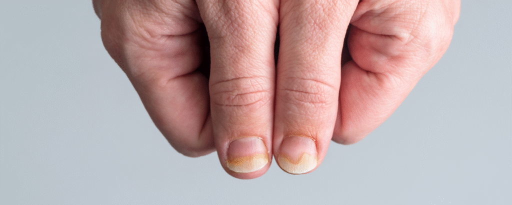 Verfärbungen, Veränderungen an den Daumennägeln, Nageldystrophie