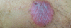 Tinea capitis u. barbae , Pilzinfektion Haut