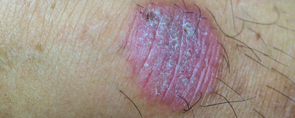 Tinea capitis u. barbae , Pilzinfektion Haut