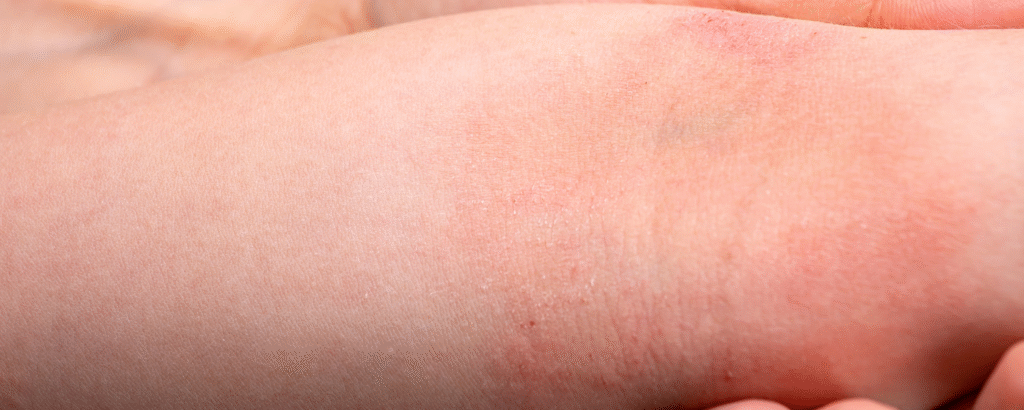 Lichenifikation am Arm