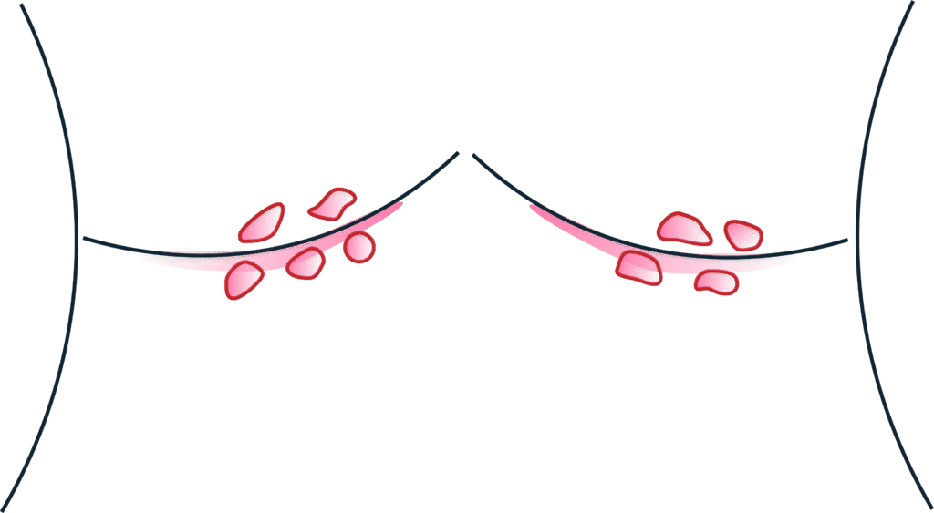 Illustration von Akne Inversa an der Brust
