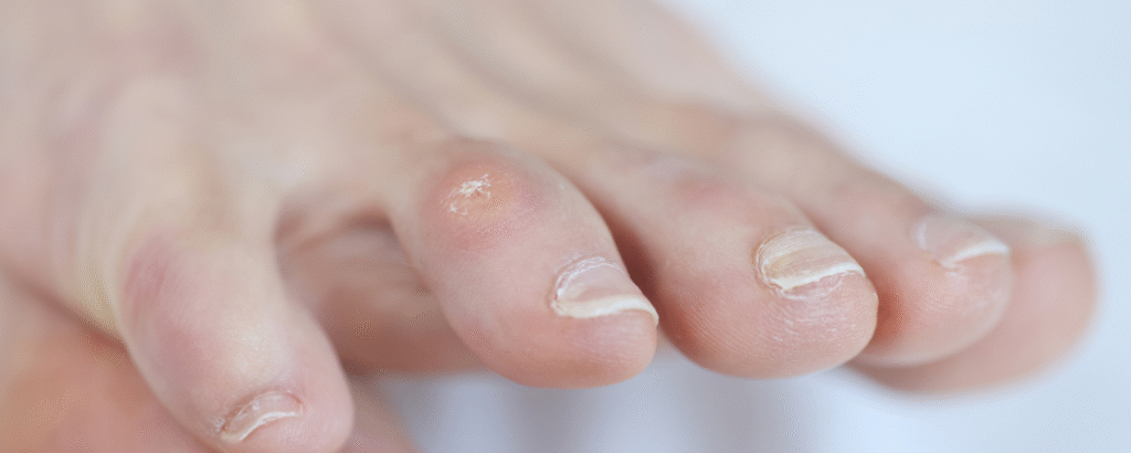 Hornhautschwiele (Hühnerauge) an einem Zeh