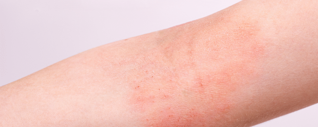 Lichenifikation (Epidermisverdickung am Arm