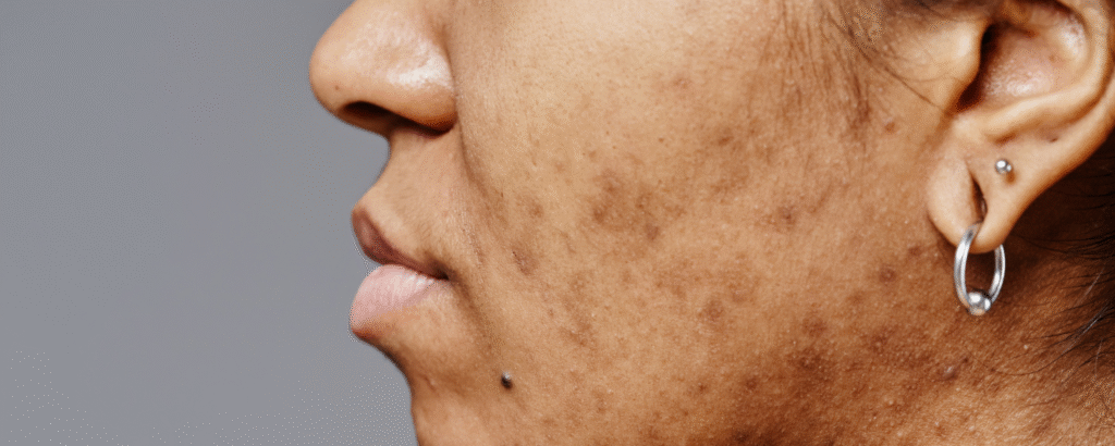 Postinflammatorische Hyperpigmentierung im Gesicht einer Frau