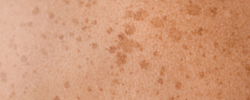 Melanin Hyperpigmentierung der Haut