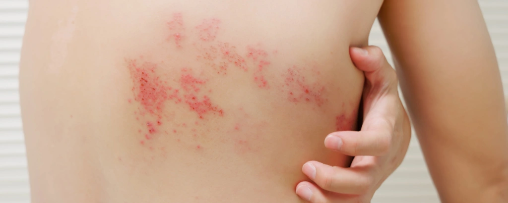 Gürtelrose am Rücken