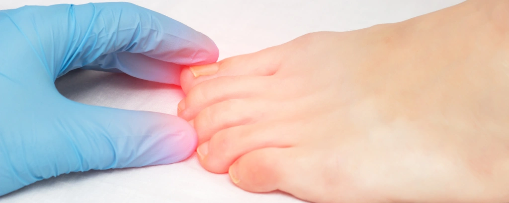 Eingewachsener Zehennagel der schmerzt