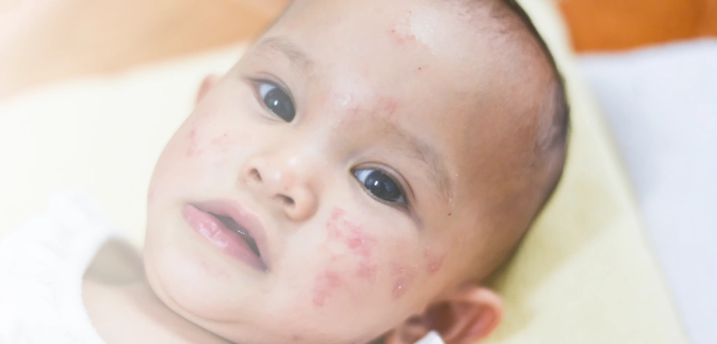Ekzem im Gesicht eines Babys