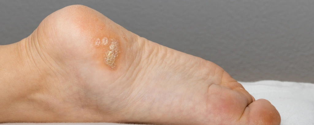 Mosaikwarze an der Fußsohle