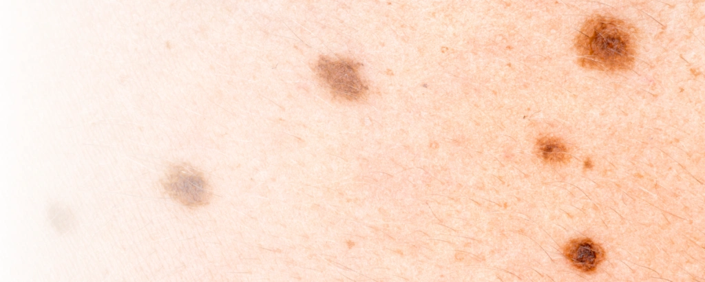 Alterswarzen (Seborrhoische Keratose)