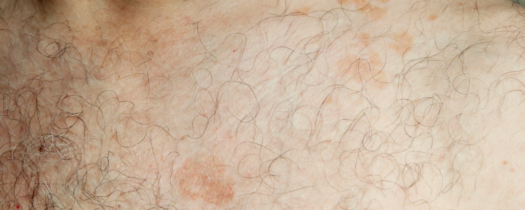Röschenflechte (Pityriasis rosea)