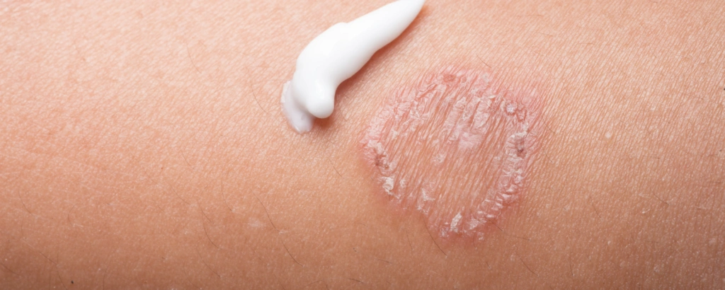 Nummulaeres Ekzem mit Creme